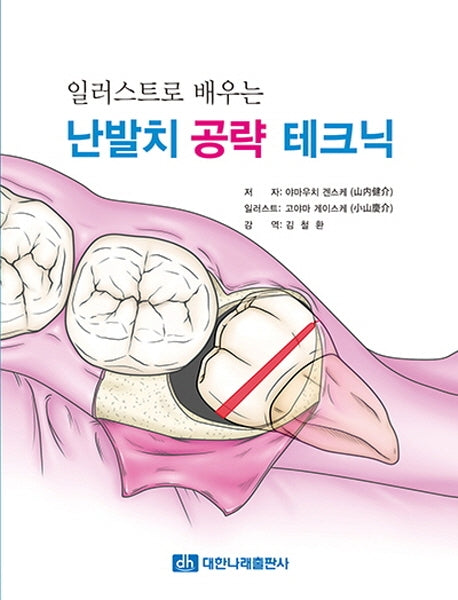 난발치 공략 테크닉(일러스트로 배우는)