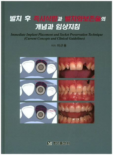 발치 후 즉시식립과 발치와보존술의 개념과 임상지침(양장본 HardCover)