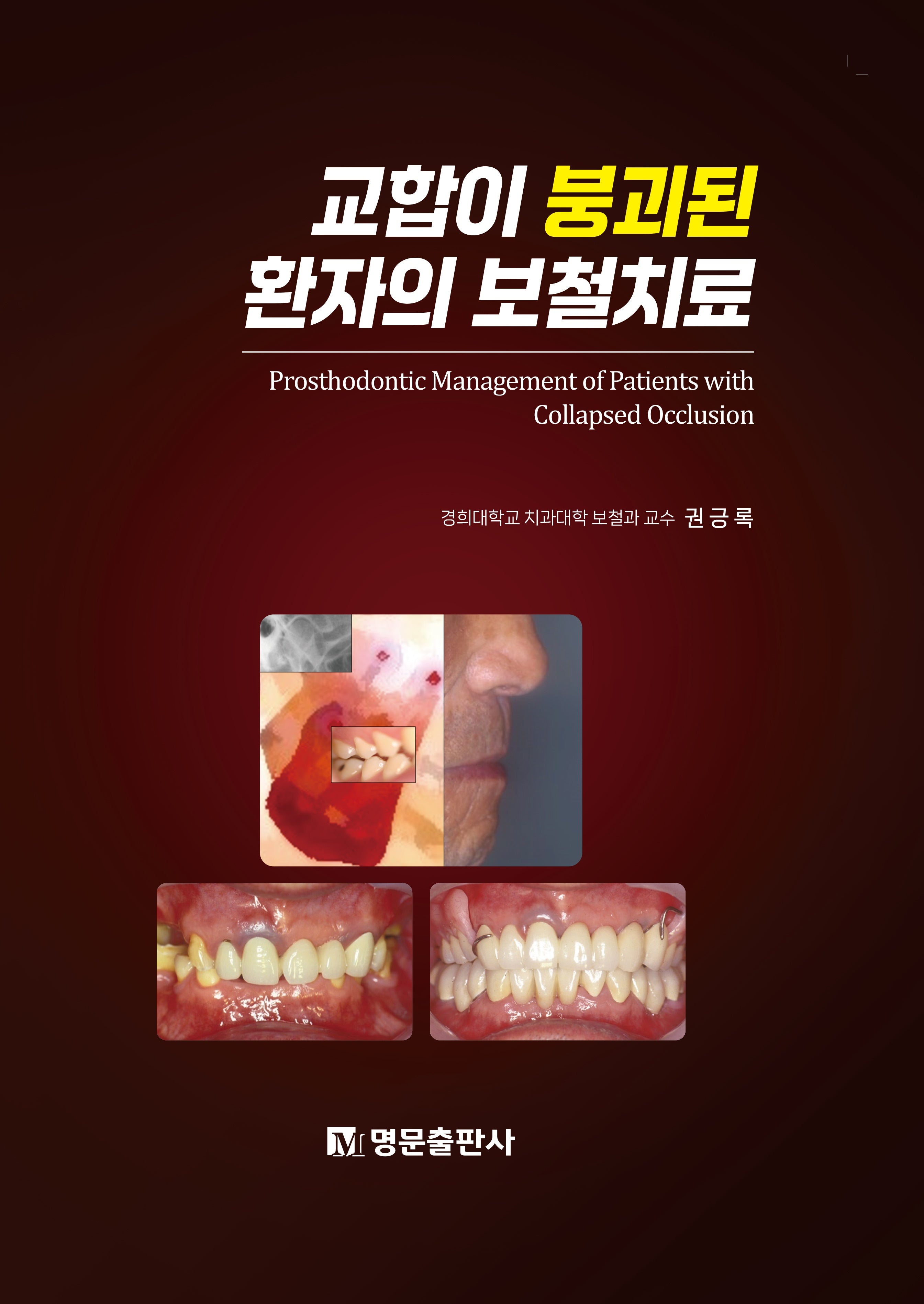 교합이 붕괴된 환자의 보철치료