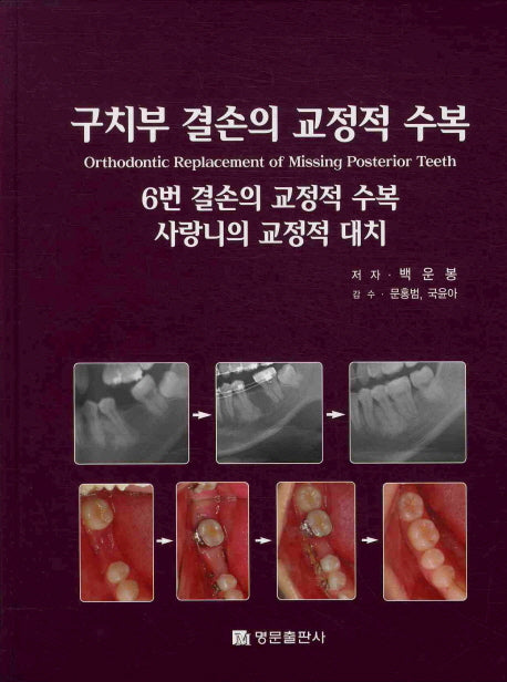구치부 결손의 교정적 수복(양장본 HardCover)