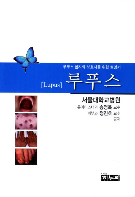 루푸스