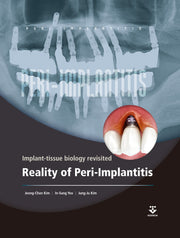 Reality of Peri-Implantitis