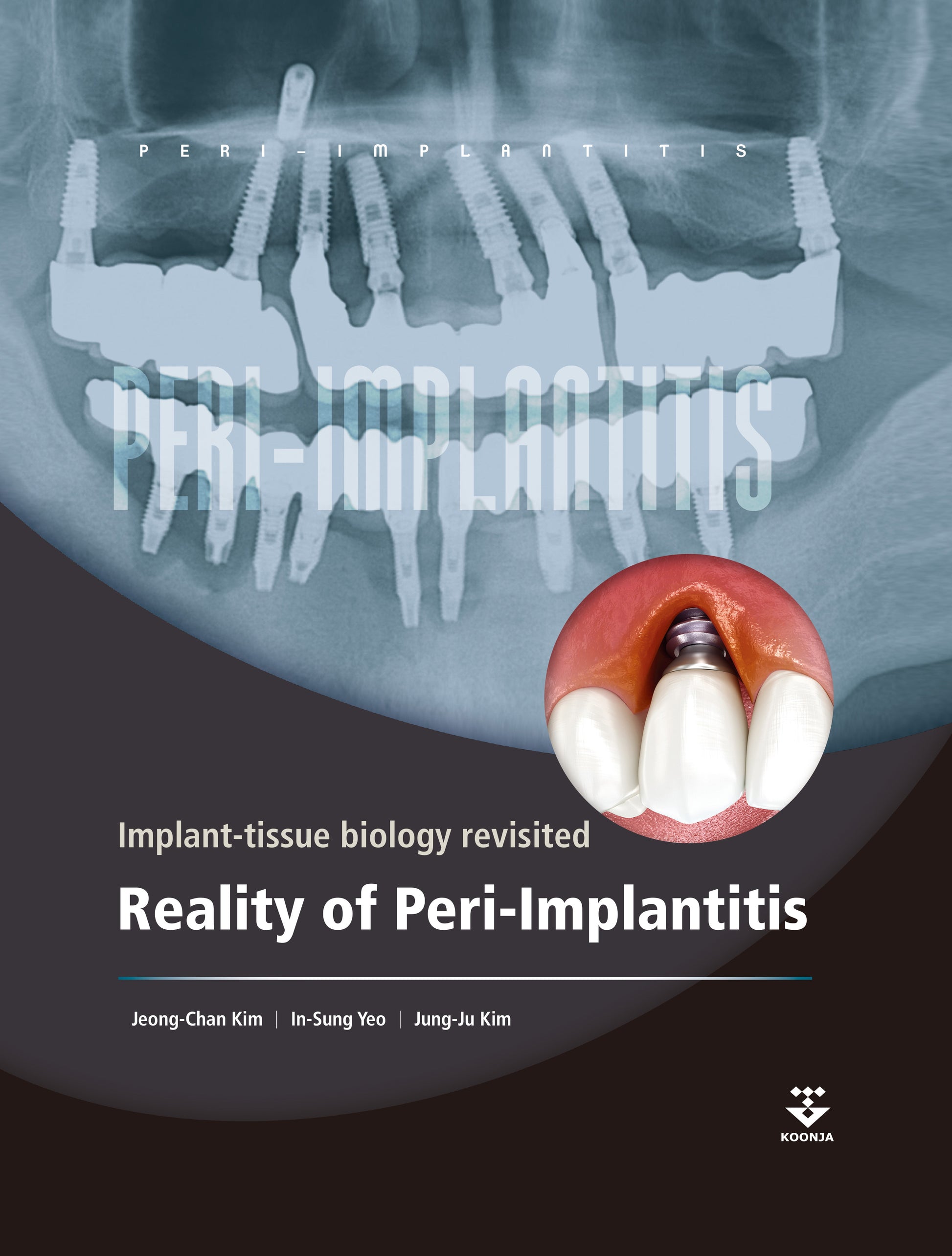 Reality of Peri-Implantitis
