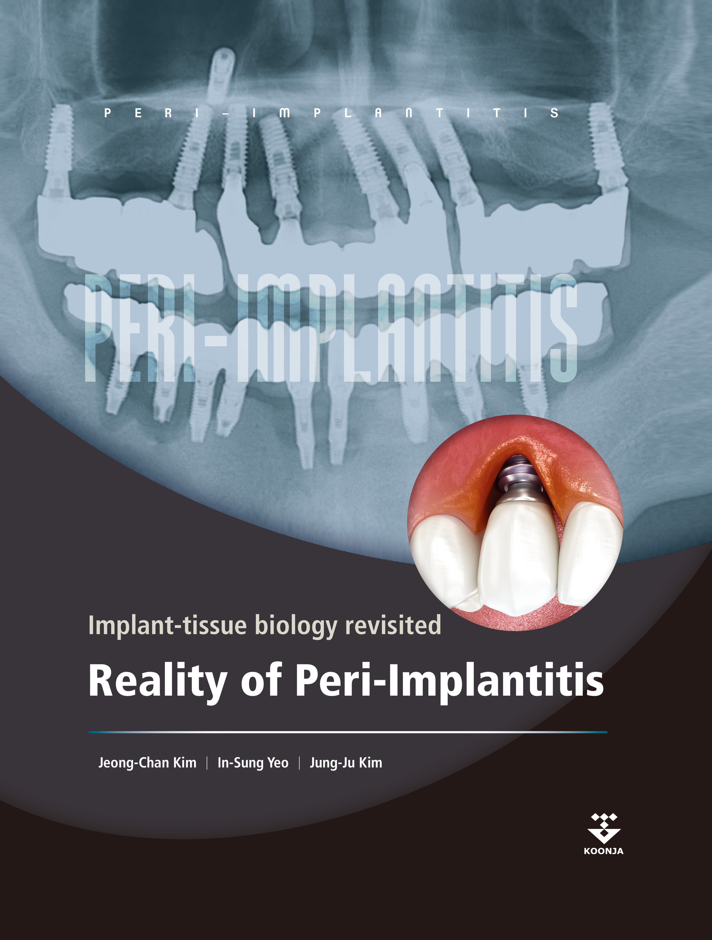 Reality of Peri-Implantitis