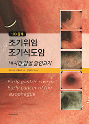 100 증례 조기위암 조기식도암
