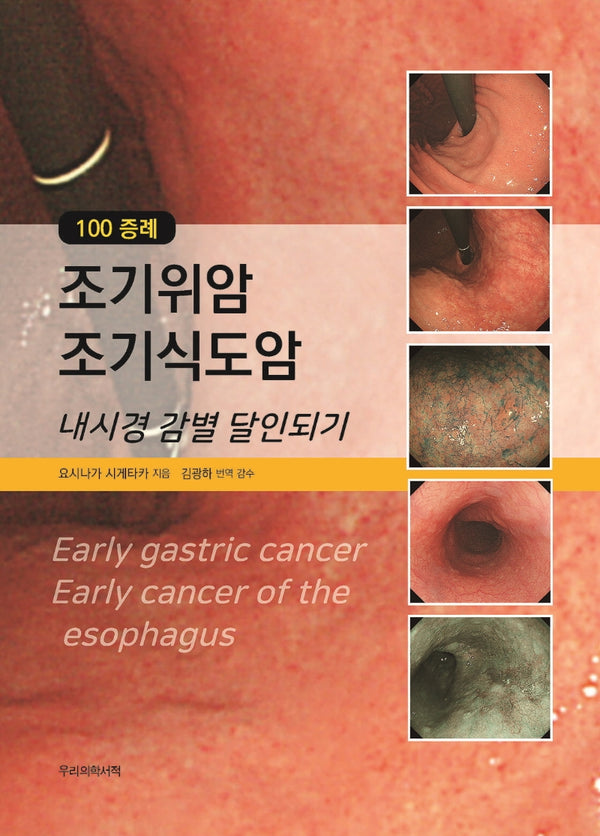 100 증례 조기위암 조기식도암